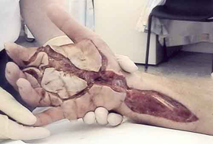 Hydraulic Oil Injection Injury Treatment Hydraulic Oil Injection Injury