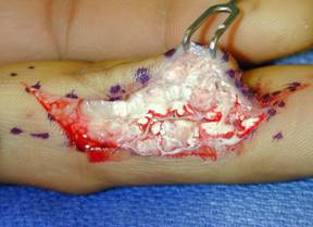 hydraulic-oil-injection-injury-finger-open
